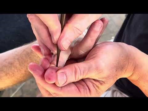 Deep hand reflexology massage using chopsticks.