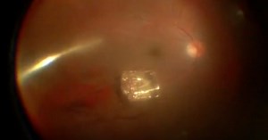 Removing Tempered Glass From the Eye - Eyetube