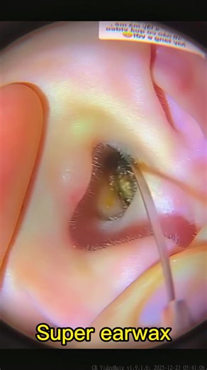 Effective Ear Cleaning Techniques for Healthier Ears