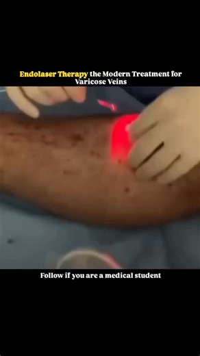 @medicalstudent.io on Instagram: "Endolaser therapy is a cutting-edge treatment for vascular veins that offers a minimally invasive approach to address varicose veins. Using laser energy, the procedure targets and seals off affected veins, helping to reduce their appearance and alleviate associated discomfort. With its quick recovery time and high success rate, Endolaser therapy has become a popular choice for those seeking a modern, effective solution to vascular issues. #endolaser #therapy #fo
