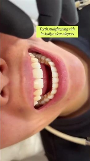 Invisalign by The Dental Room