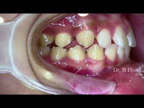 Non-extraction Non-surgical treatment to correct severe overbite