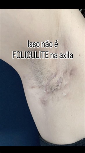 Parece FOLICULITE, mas é HIDRADENITE SUPURATIVA #foliculite #hidradenitesupurativa