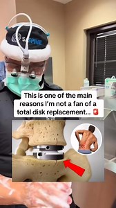 129K views · 909 reactions | This is one of the main reasons I'm not a fan of a total disk replacement... #tlif #adr #totaldiscreplacement #doctorreacts #doctorexplains…. @topfans @followers | SASpine | Facebook