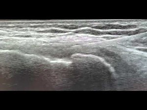 Ultrasound guided medial collateral ligament (MCL) injection