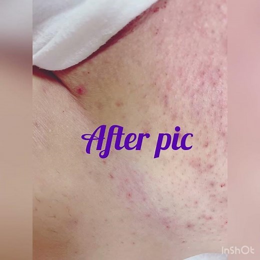 Male Brazilian wax with ingrown hair