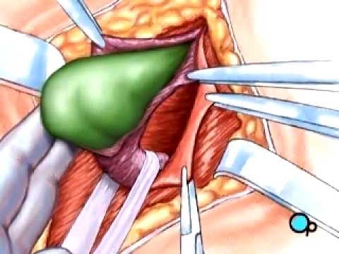PreOp® Patient Education: Hernia Repair Inguinal Surgery 1