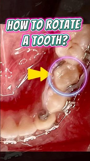 Rotate a Tooth with Braces (Couple Moment) 🔄