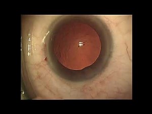 acute corneal epithelium detachment during phacoemulsification