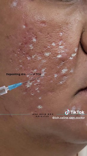 Effective Ice Pick Acne Scar Treatments | TCA Cross Procedure