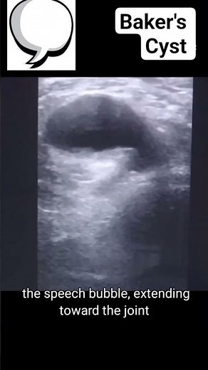 Baker's cyst on ultrasound #radiology #ultrasound