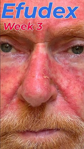 Efudex Treatment – Week 3 Update (Fluorouracil 5% Skin Cancer Journey)