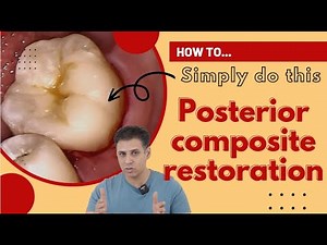 How to Replace An Old Posterior Composite Restoration | Important Hints And Guides For Dentists • Video • MEDtube.net