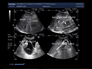 Ultrasound Video showing multiple findings including hepatic mass and mass in porta hepatis.