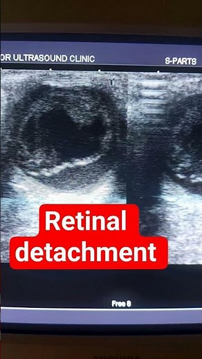Retinal detachment.. Scan #ultrasound