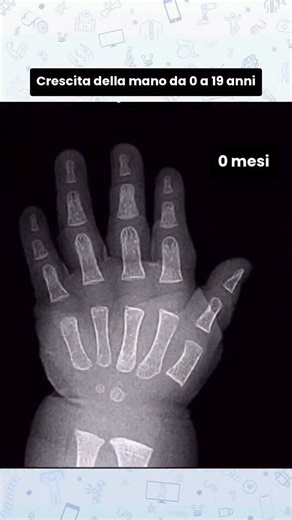 buonrecupero on Instagram: "Sapevi che non nasciamo con le stesse ossa che abbiamo da adulti? Anche se può sembrare strano, un neonato ha circa 270 ossa, mentre un adulto ne ha circa 206. Ma allora… che fine fanno tutte quelle ossa che “scompaiono”? 👀 La risposta è nella cartilagine. Alla nascita, molte strutture non sono ancora ossa vere e proprie: sono più flessibili, adattabili, progettate per facilitare il parto e permettere la crescita. Con il tempo, grazie ai centri di ossificazione, ques