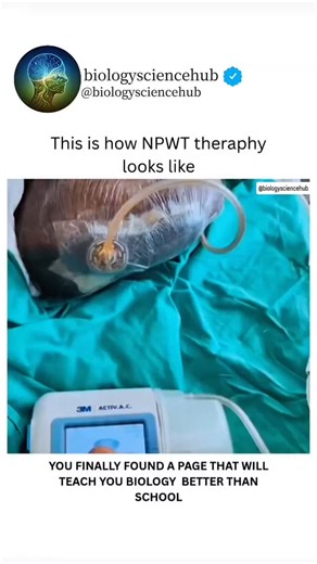 BIOLOGY UNIVERSE on Instagram: "This is how NPWT (Negative Pressure Wound Therapy) looks like in real life — a powerful tool in modern wound care that supports faster and safer healing. NPWT works by applying controlled suction to the wound through a sealed dressing system. This gentle negative pressure helps remove excess fluid, reduce swelling, and promote healthy tissue growth while protecting the wound from outside contamination. It may look complex at first glance, but every part of this se