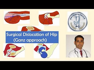 Safe surgical dislocation of Hip (Ganz Approach)