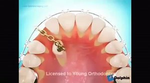 22K views · 42 reactions | Impacted Canine Alignment by Orthodontics. | Dr.Tanveer's Dental Surgery | Facebook