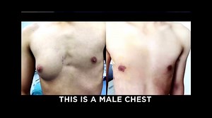Did hormones in fast food cause this man to grow a breast? Many doctors think so. For more on this discussion, visit http://bit.ly/2yN3gbh. | The Doctors