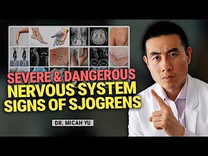 Severe and Dangerous Nervous System Signs of Sjögren’s