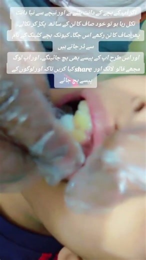 Milky tooth extraction pain free#foryoupageofficiall #foryou