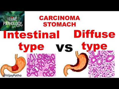 Carcinoma Stomach: INTESTINAL VS DIFFUSE GASTRIC CANCER
