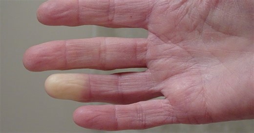 NHS says 'skin may change colour' if you have weather-linked issue