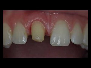 Subgingival preparation and nonsurgical gingival contouring with a temporary restoration