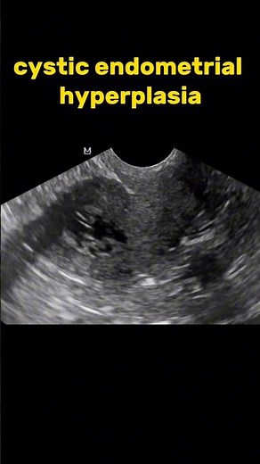 Cystic endometrial hyperplasia ultrasound /radiology/sonology