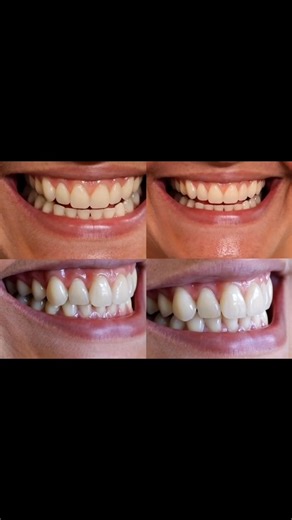 I'm passionate about my work ❤️ I'm a Dental Prosthesis Technician, Specialist in Complete Dentures, and Prosthodontist. Dr. Samuel Silva 🇧🇷 #DentalImplants #dentistry #prosthodontist #smile #dentist #cosmeticdentistry #dentistry #CosmeticDentistry #dentures #smile | Tpd Samuel Silva