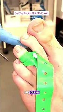 Stubborn fungal toenails on the 3rd toe!