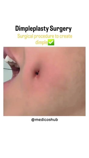 Dimpleplasty Surgery✅️ #MedicalEducation #Healthcare #FutureDoctor #MedStudent #AlliedHealth #PreMed