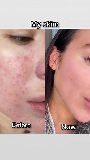 Transforming Acne Marks with Caudalie Skincare