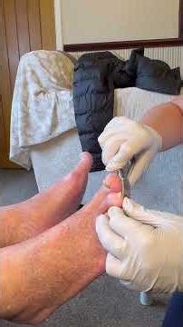 Toe nail clipping #footcare #healthiswealth #foottreatment