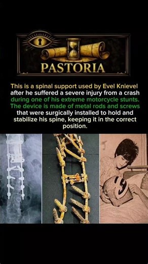 This Was Implanted in a Patient’s Spine#history #short