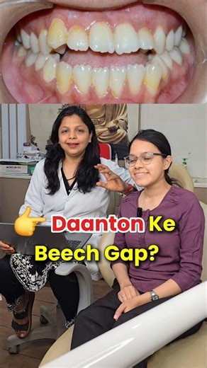 How to Close Gap Between Front Teeth | Teeth Gap Treatment #viral #trending