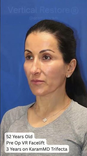 From 51 years old back to 24 again... Facelift Before & After