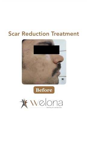 Welona Slimming Skin Hair on Instagram: "From visible scars to smoother, healthier-looking skin - here’s progress you can actually see. ✨ With our advanced scar reduction treatment, we focus on fading scars, boosting collagen, and improving skin texture. Real results with consistent care. Want to know the name of the treatment? Comment “Scar” below. [Scar Reduction Treatment, MNRF, Microneedling, Surgical scar, Acne scars, Laser treatment, Open pores, Textured skin, Pigmentation removal, Skin la