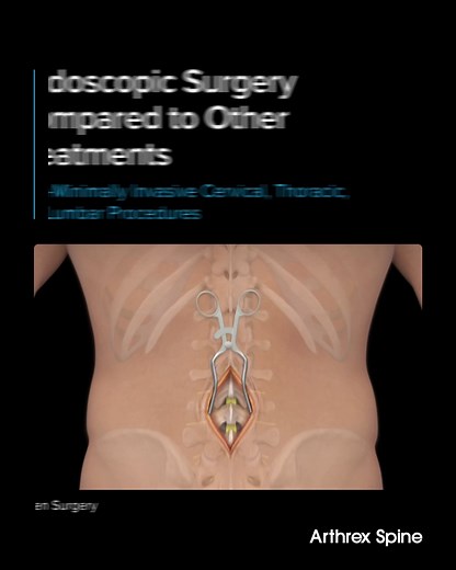 Traditional, or open, spine surgery requires a large incision, which often damages the paraspinal muscles that help you move your torso. It may also involve removing more bone to access certain areas, leading to more pain and a longer recovery time. In contrast, endoscopic spine surgery allows your surgeon to use specialized instruments, including an endoscope, to view and operate on the spine through a much smaller incision. By avoiding large incisions, minimizing tissue disruption, and reducin