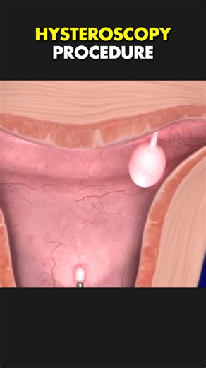Healthy..lifestyle | Hysteroscopy Procedure (3D Animation) #hysteroscopy #hysteroscopysurgery #hysteroscopyprocess | Instagram
