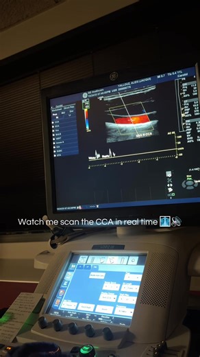Exploring the Satisfying CCA Waveform in Ultrasound