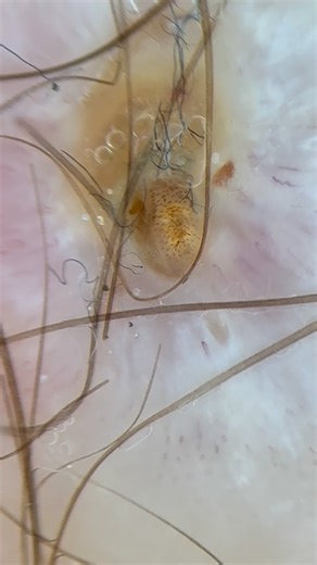 Dermoscopy - Skin cancer on Instagram: "Dermatobia hominis - larva Courtesy of @bedingustavo 📸 @dermlite DL5 #dermatology #dermatologia #skin #pele #medicine"