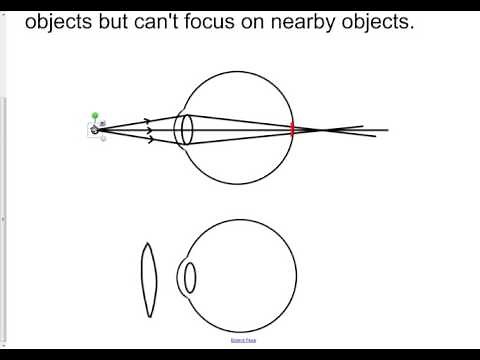 Short and long sight correction