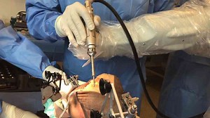 Robotic Knee and Hip Replacement Surgery
