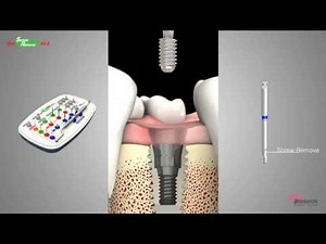 How to Use the NeoBiotech Screw Remover Kit