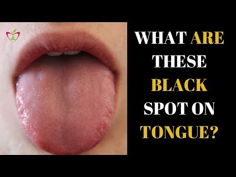 What Are These Black Spot On My Tongue || How to Get Rid of Black Spots On Tongue ||