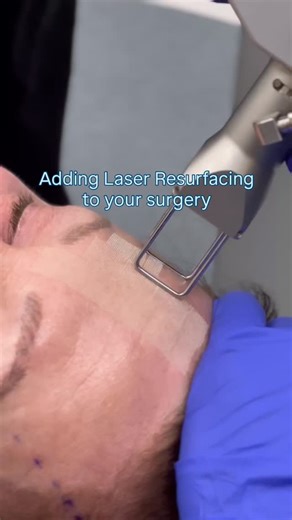 Combining laser resurfacing with your surgery allows me to address both structure and skin quality at the same time. 👏🏼 While surgery focuses on lifting and repositioning, laser treatments improve texture, tone, fine lines, and sun damage. Performing these together often means a single, more efficient recovery period rather than separate downtimes. The result is smoother, more even looking skin that complements the surgical outcome. 🙌🏽 ☎️ (949) 650-8882 📍 Newport Beach Beverly Hills . . . #