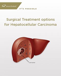 30K views · 326 reactions | Hepatocellular Carcinoma is a primary...