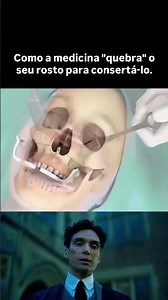 O vídeo ilustra uma osteotomia um procedimento ortognático o #Shorts